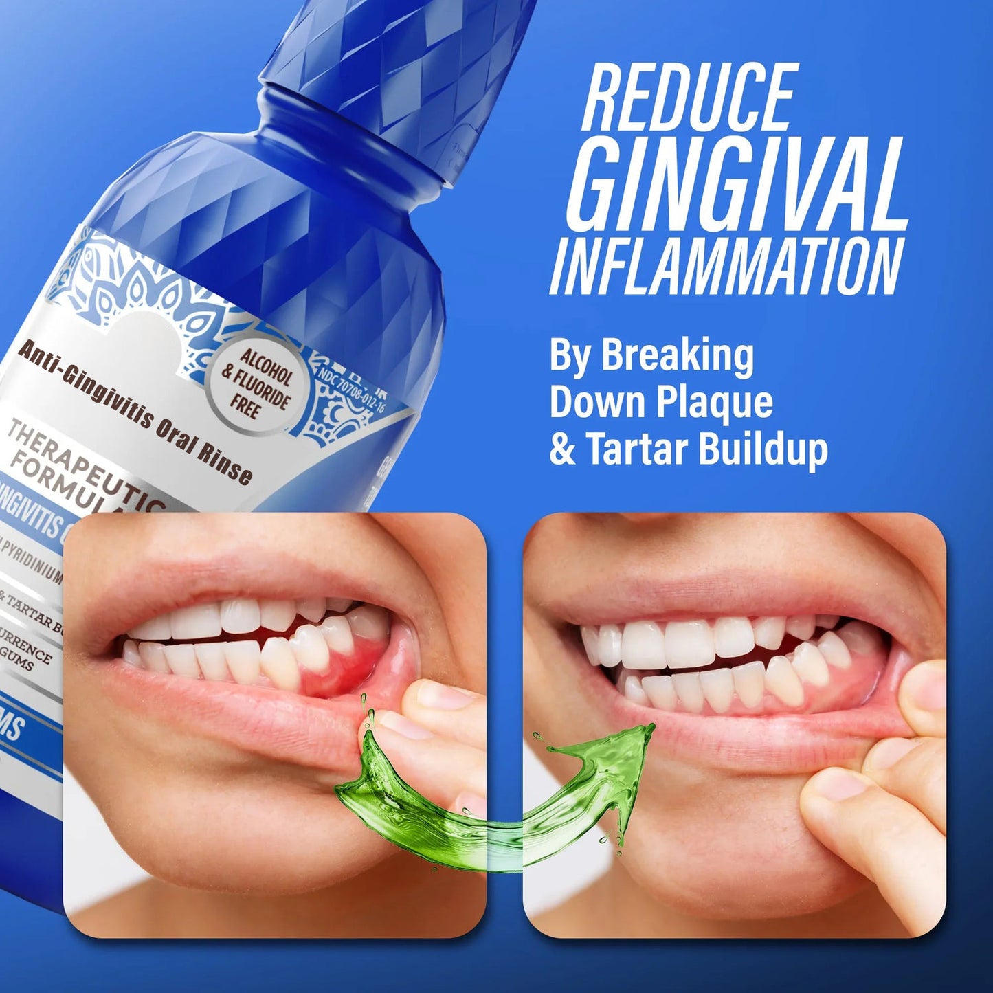 Anti-Gingivitis Therapeutic Oral Rinse Mouthwash